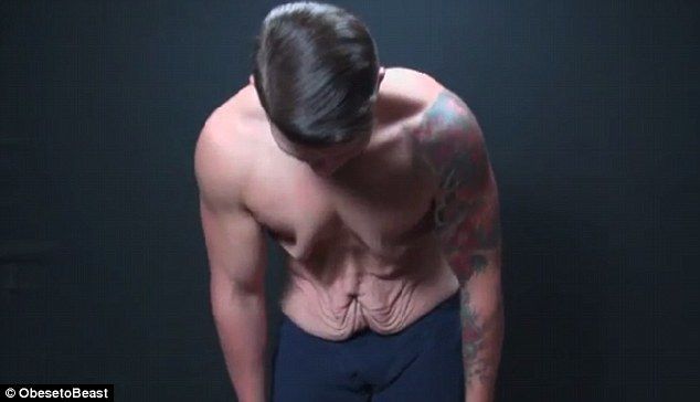 21-летний парень, похудевший на 72,5 кг, показал свое тело с обвисшей кожей в движении